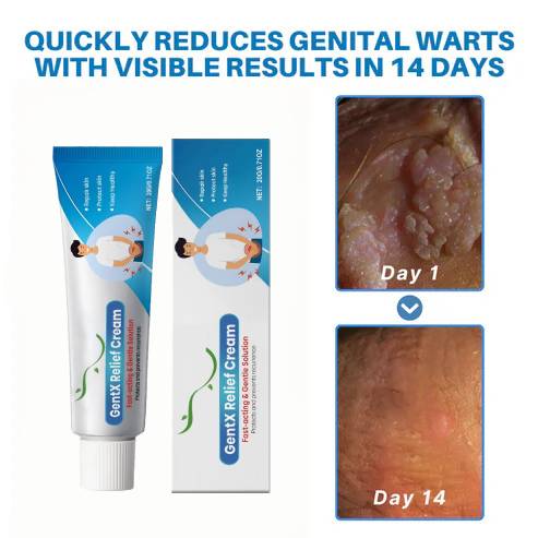 🌈🌞 Sale🌞🔥30 - Day Free Returns💰lirayn HPV Genital Warts Relief Cream🔥 - store