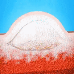 🌈🌞 Sale🌞🔥30-Day Free Returns💰lirayn HPV Genital Warts Relief Cream