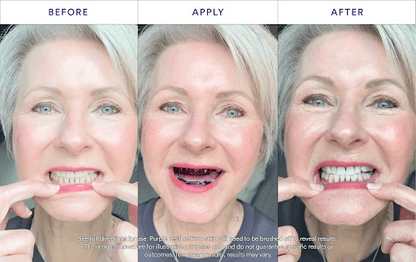 👨‍⚕️Purple Teeth Whitening Strips:Revolutionary Dissolving Diamond Series Technology with Hydroxyapatite 💎